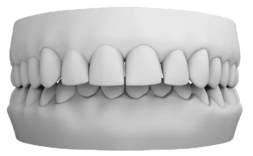 Overjet vakası – öne çıkık üst ön dişler