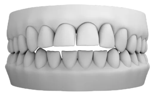 Açık kapanış ortodontik vaka – ön dişler temas etmiyor