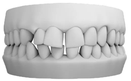 Dişler arasında boşluk bulunan spacing vakası görseli