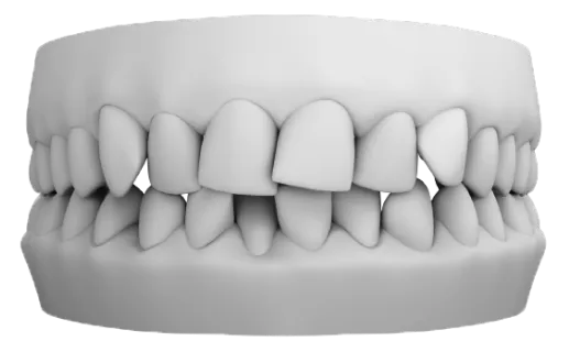 Çapraz kapanış (crossbite) örneği – ön ve arka dişlerde hizasızlık