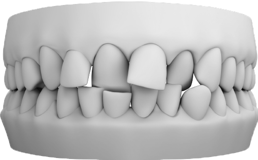 Crossbite ortodontik vaka görseli – ön ve arka dişlerde çapraz kapanış örneği