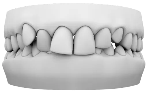 Derin kapanış – alt dişleri fazlaca örten üst dişler