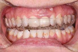 okluzal-splint-2