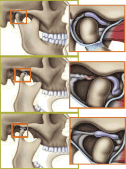 okluzal-splint-3