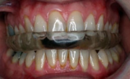 okluzal-splint-5