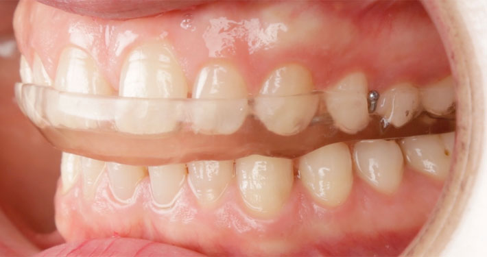 okluzal-splint-6